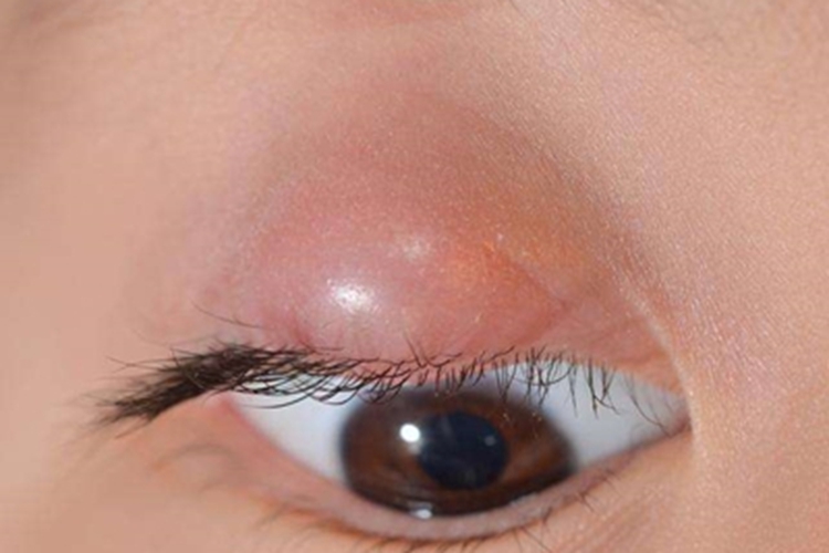 急性眼眶蜂窝织炎眼睑症状图 急性眼眶蜂窝织炎眼睑症状图