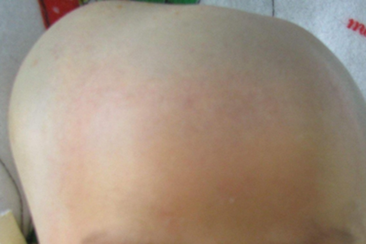 骨膜下血肿头部症状图