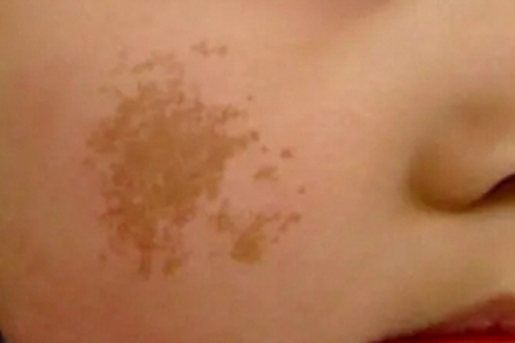 伊藤痣面部症状图