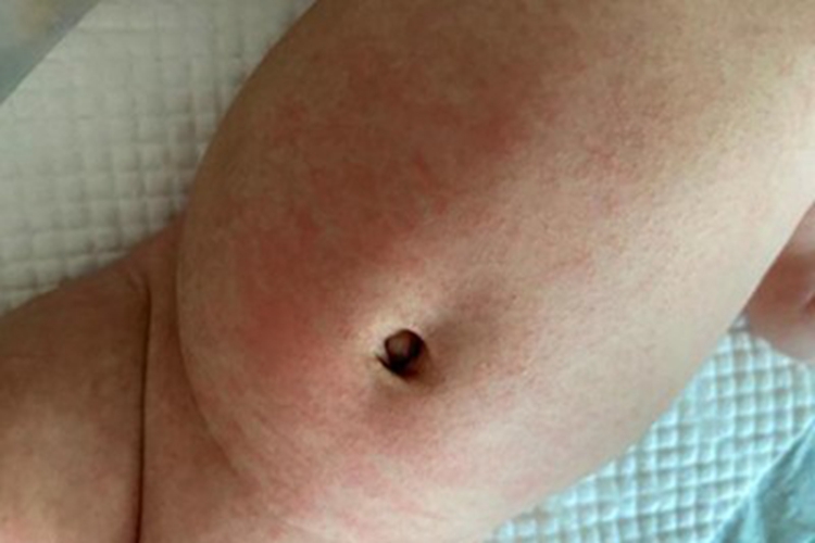 脓疱病上腹症状图 脓疱病上腹症状图