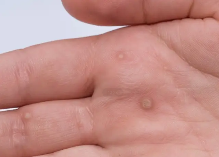 手掌扁平疣图