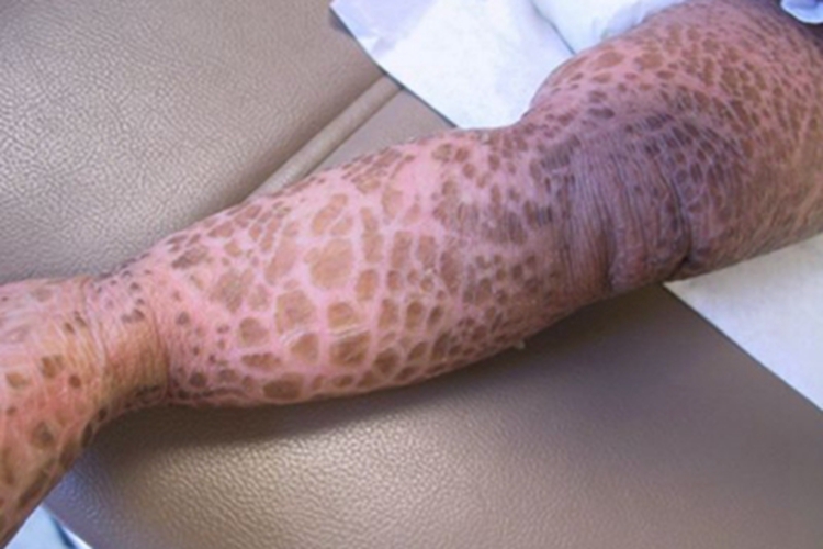 毛囊性鱼鳞病腿裂纹图