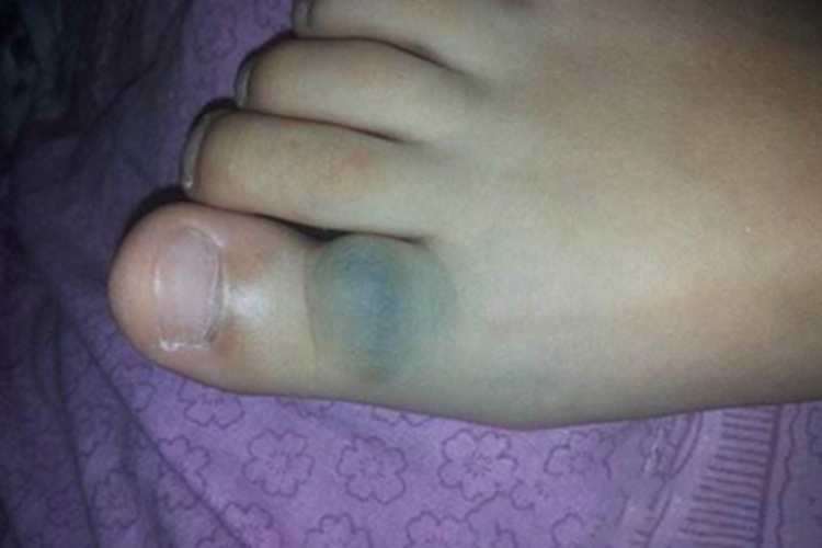 深在型婴儿血管瘤脚部症状图