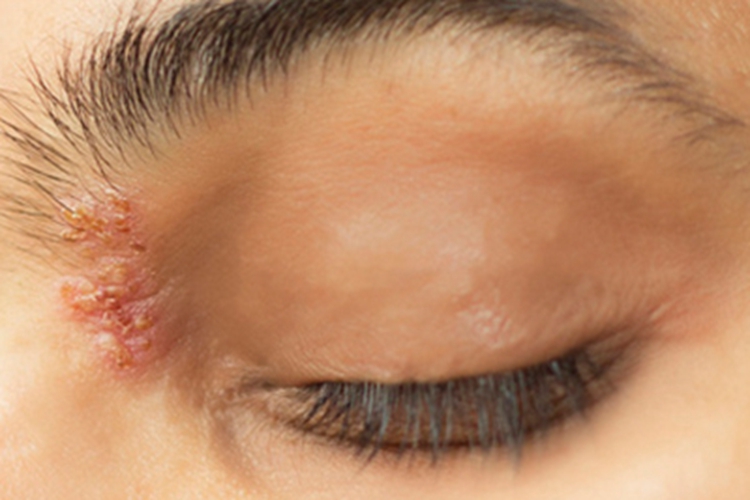 眼角单纯疱疹水疱图
