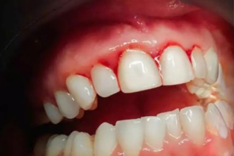 坏血病引起牙龈肿胀出血图 坏血病引起牙龈肿胀出血图