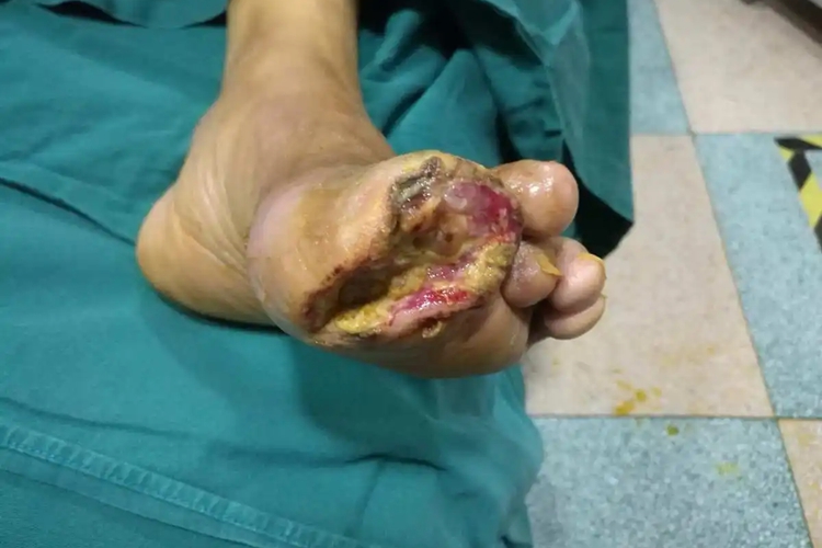 湿性坏疽脚趾渗液图