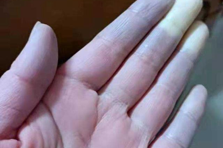 混合结缔组织病手指苍白图