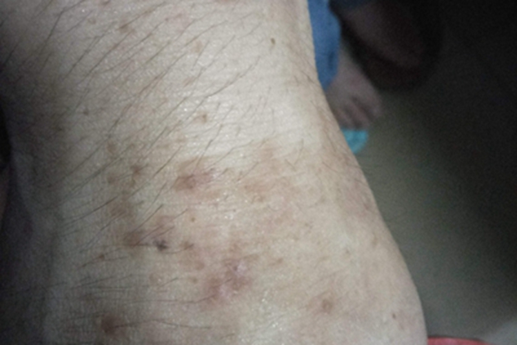 炎症后色素沉着脚踝斑图