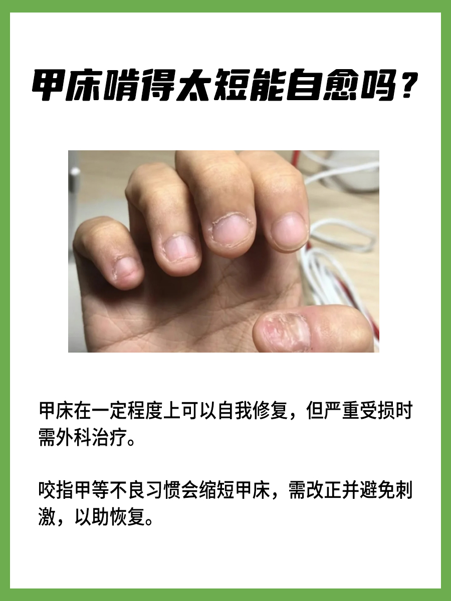 甲床啃得太短能自愈吗？答案来喽！