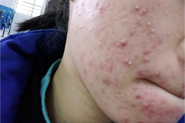 痤疮面部很多疙瘩冒白尖图