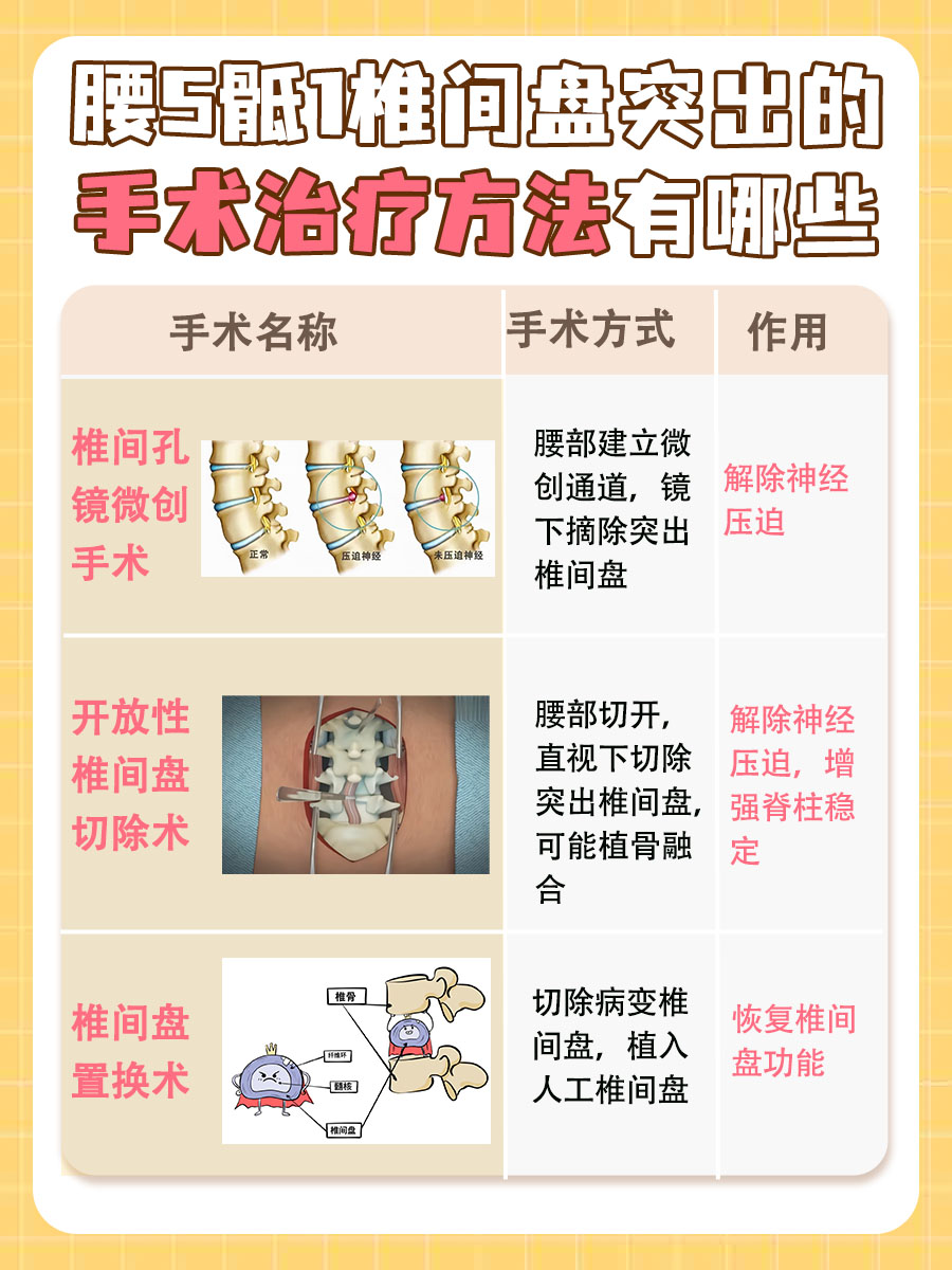 探究！腰5骶1椎间盘突出最佳锻炼方法