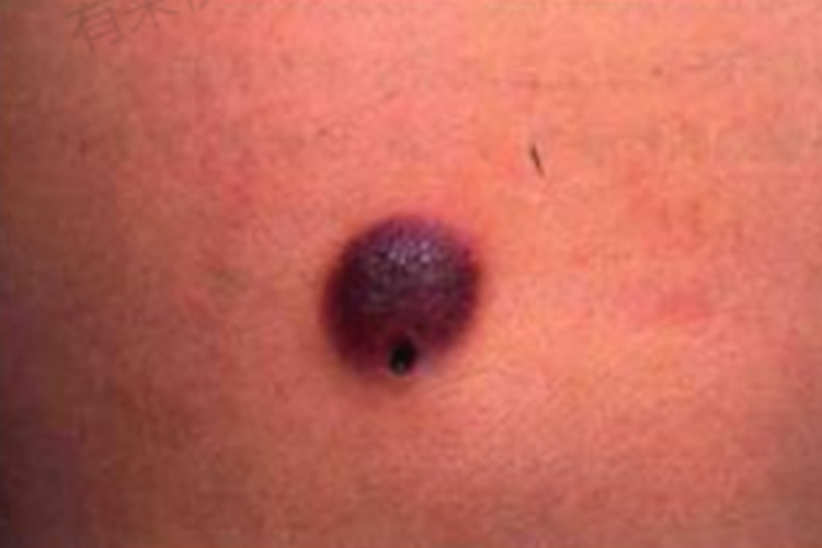 白血病特异性皮肤图