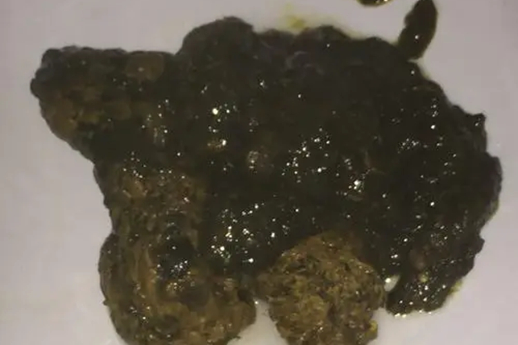 慢性胃炎大便图