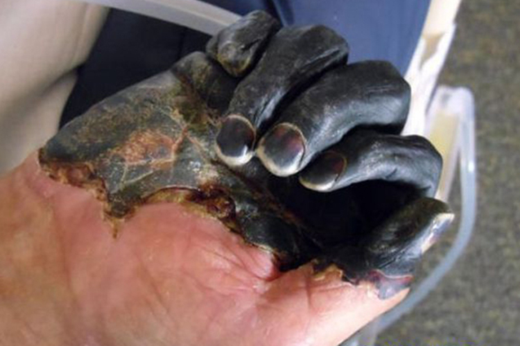 黑死病症状图 黑死病症状图