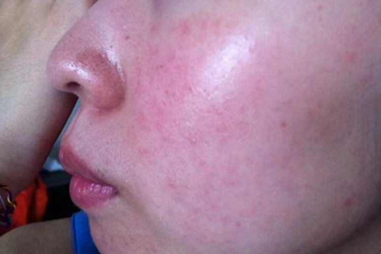 糖皮质激素依赖性皮炎面部丘疹图 糖皮质激素依赖性皮炎面部丘疹图