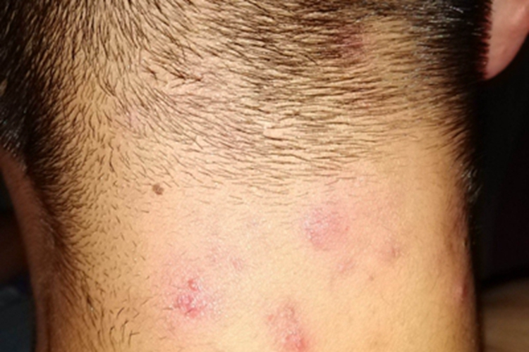 项部瘢痕疙瘩性毛囊炎后颈红斑图