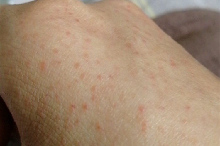 皮肤白血病长红点图 皮肤白血病长红点图
