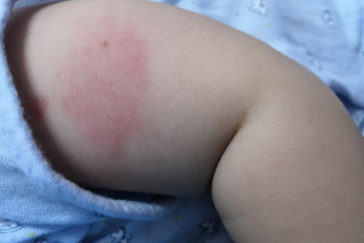 宝宝打百白破红肿图