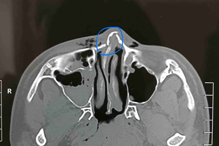 鼻梁骨折影像检查图