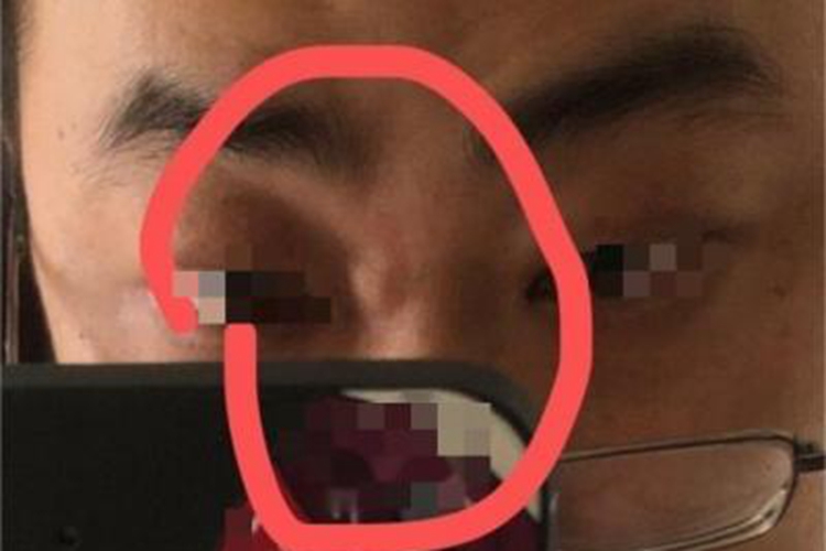 皮脂腺囊肿鼻部症状图 皮脂腺囊肿鼻部症状图