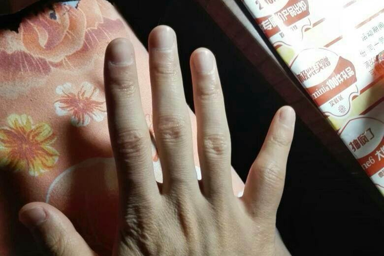 小拇指关节鼓包图片