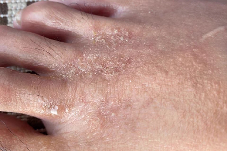 浸渍糜烂型足癣渗液图