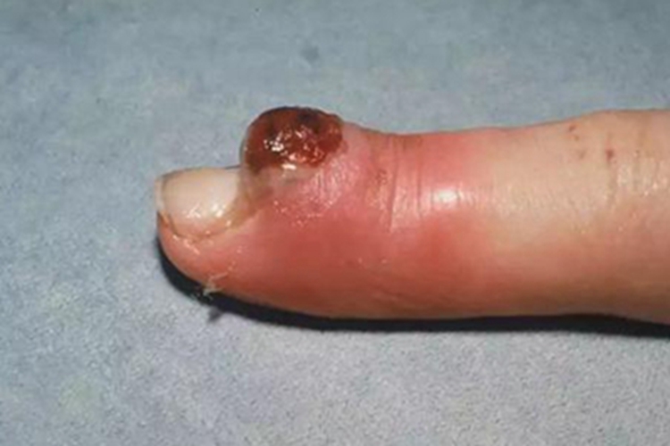 毛发肉芽肿手指结节红肿图