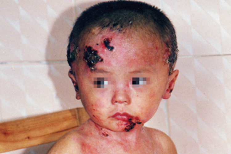 获得性大疱性表皮松解症黑痂图