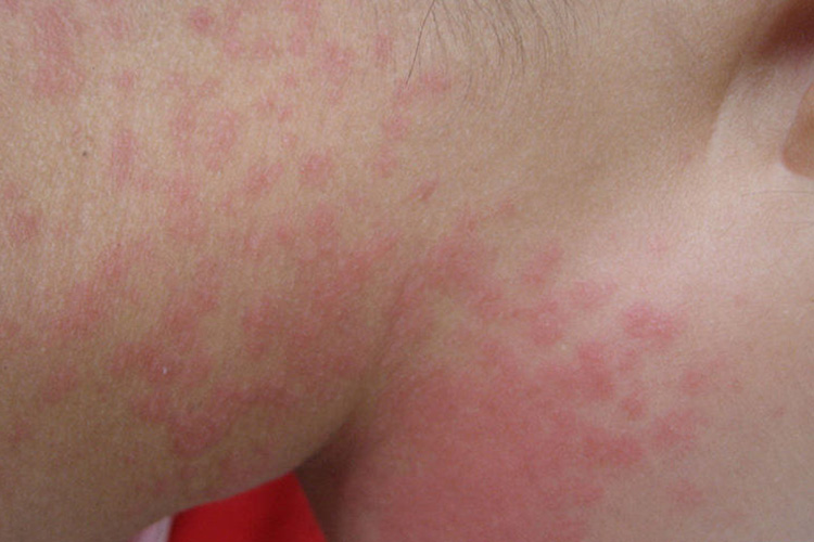 颈部螨虫皮炎图