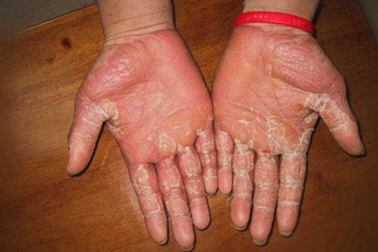 甲状腺功能减退症手掌脱皮图
