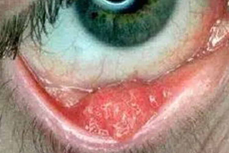 结膜乳头状瘤长瘤图