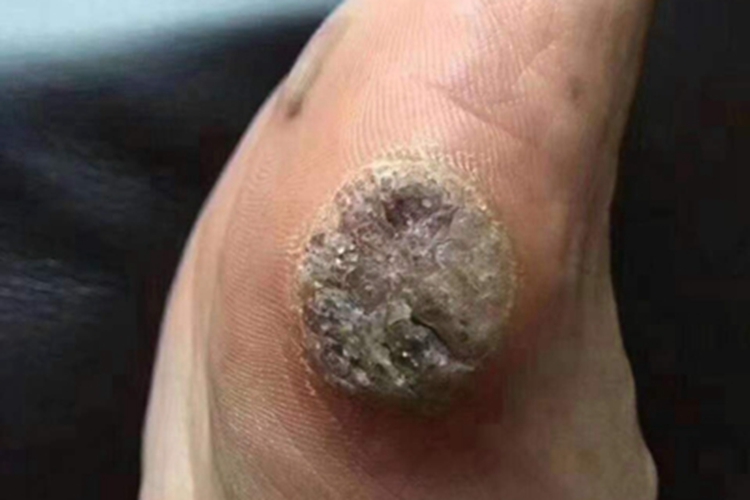 寻常疣脚部症状图 寻常疣脚部症状图
