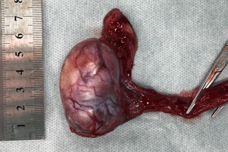 睾丸肿瘤的图片