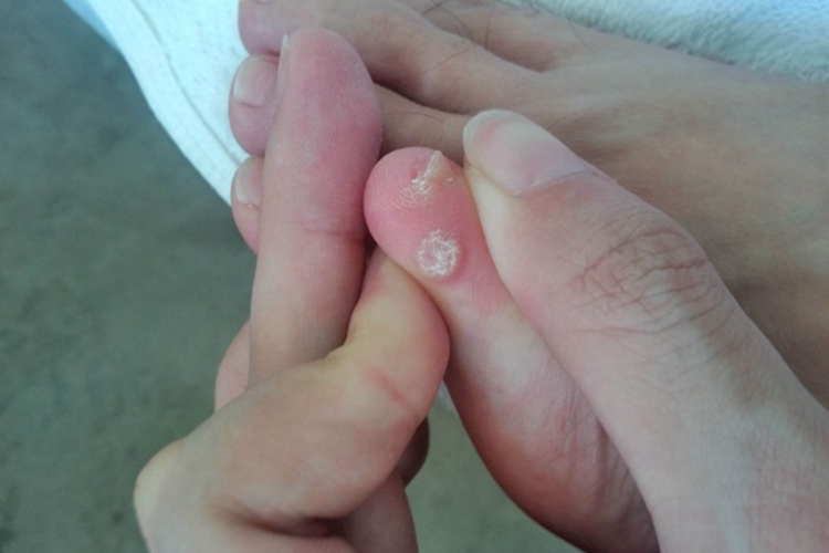 软鸡眼脚部症状图