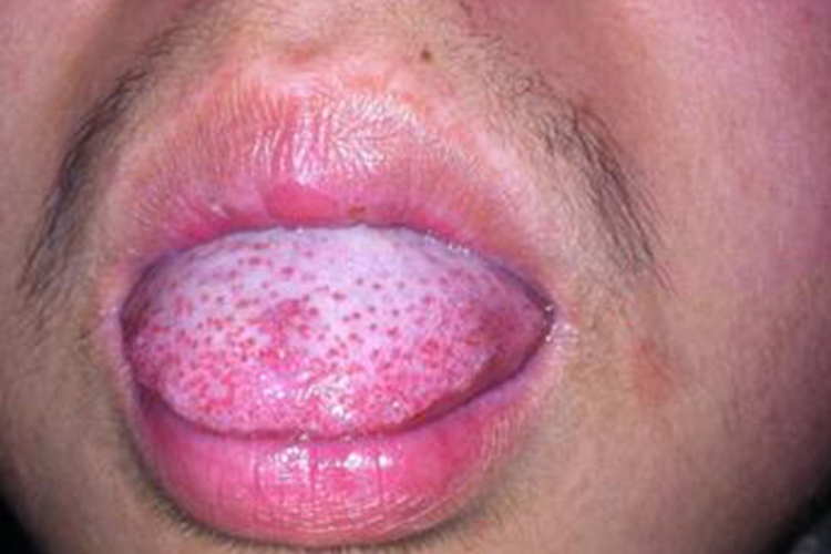 菌状乳头炎图 菌状乳头炎图