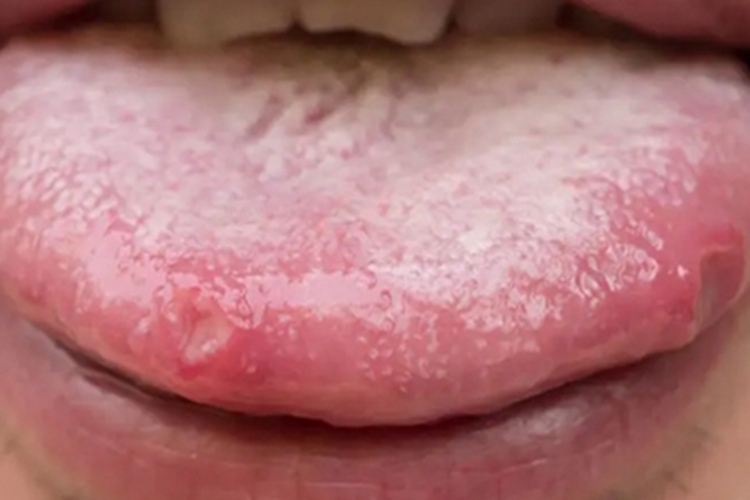 锌缺乏症舌尖烂坑图 锌缺乏症舌尖烂坑图