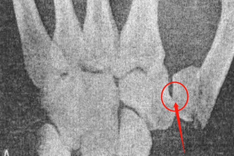 大多角骨骨折X线图