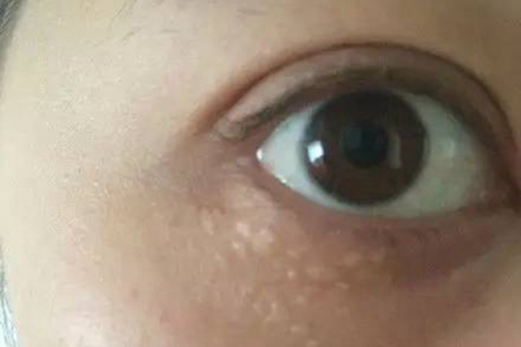 汗腺瘤下眼睑长小疹子图