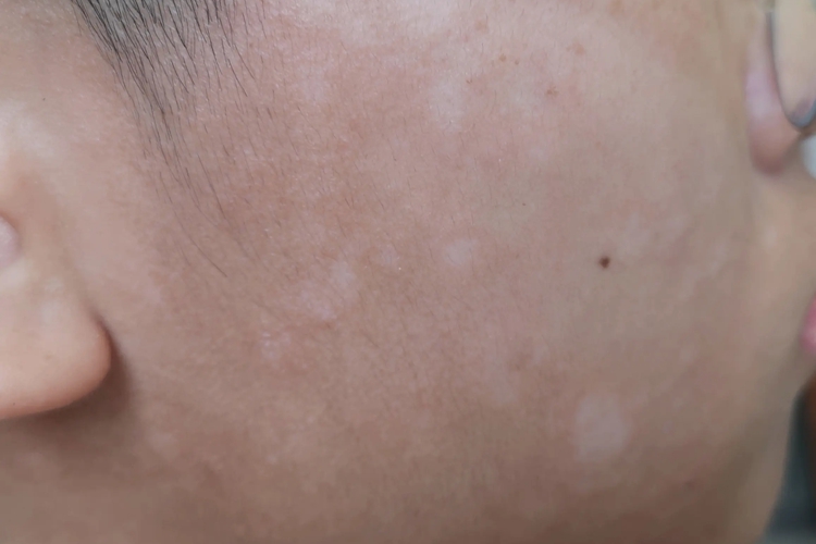 面部白色糠疹白点点图