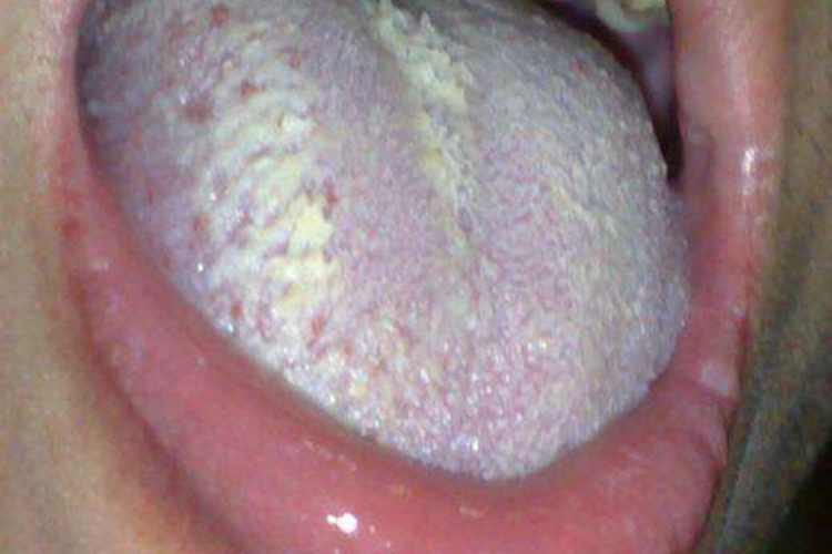 口腔毛状白斑图