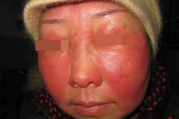 面部变应性接触性皮炎面部水肿图