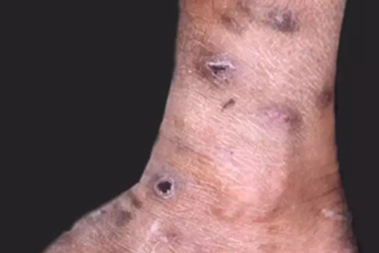 瘤型麻风结痂图 瘤型麻风结痂图