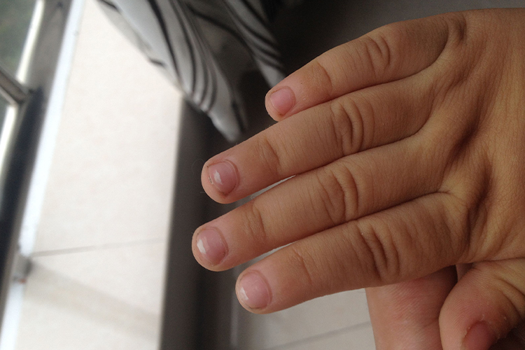 儿童甲真菌病图 儿童甲真菌病图