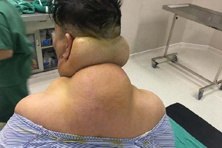 脖子两侧脂肪瘤图