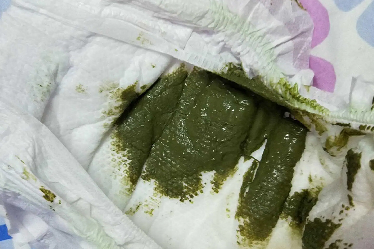 墨绿色淤泥状大便图 墨绿色淤泥状大便图