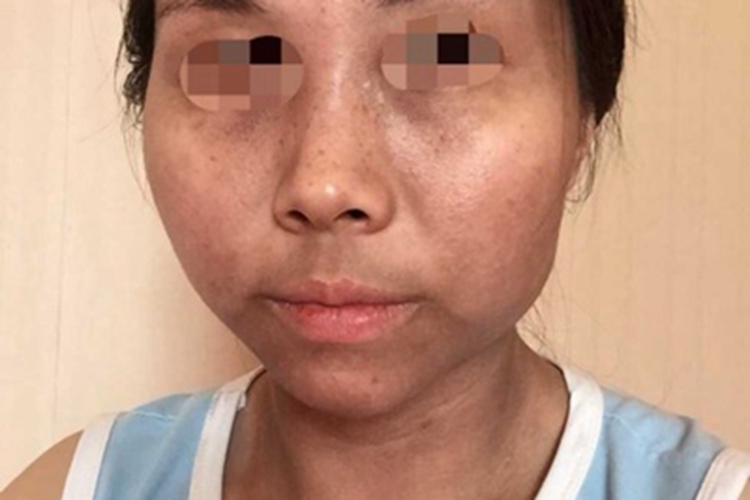 炎症后色素沉着面部症状图