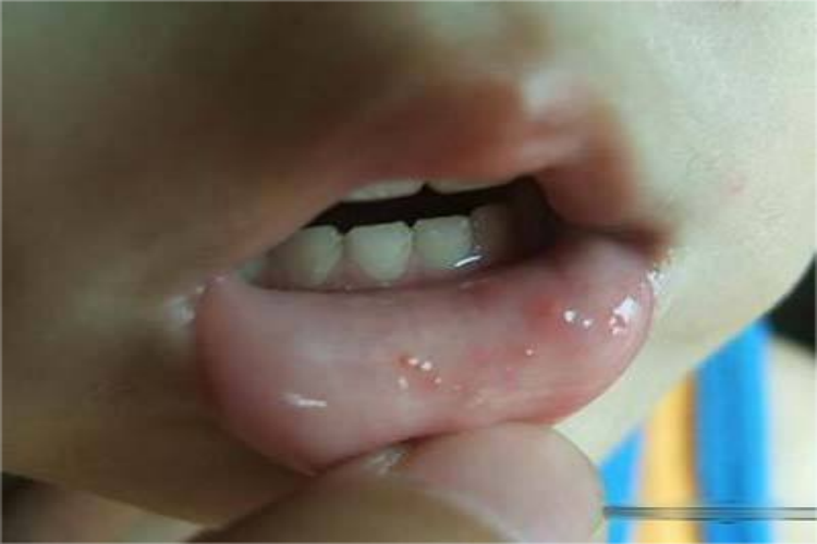 手足口病口腔内壁红点图