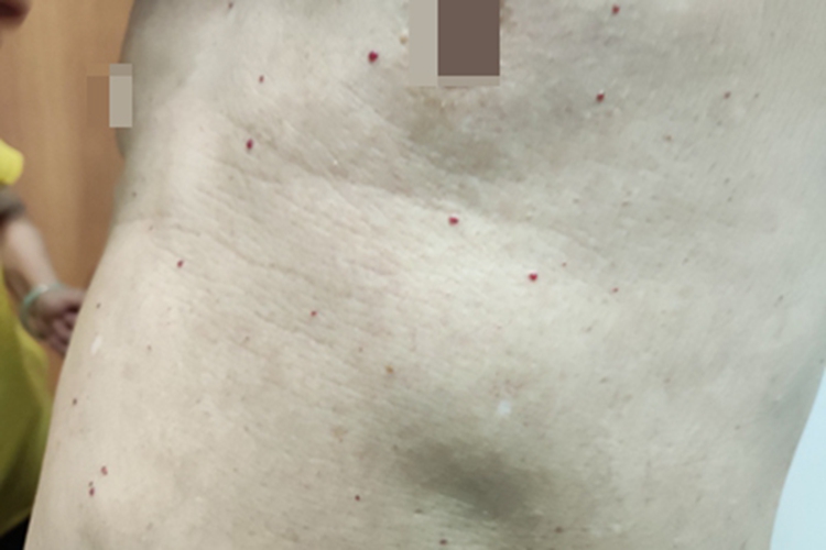 毛细血管瘤红点图 毛细血管瘤红点图