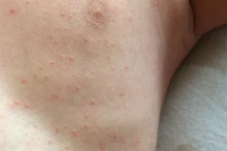 小孩腹部特应性皮炎图