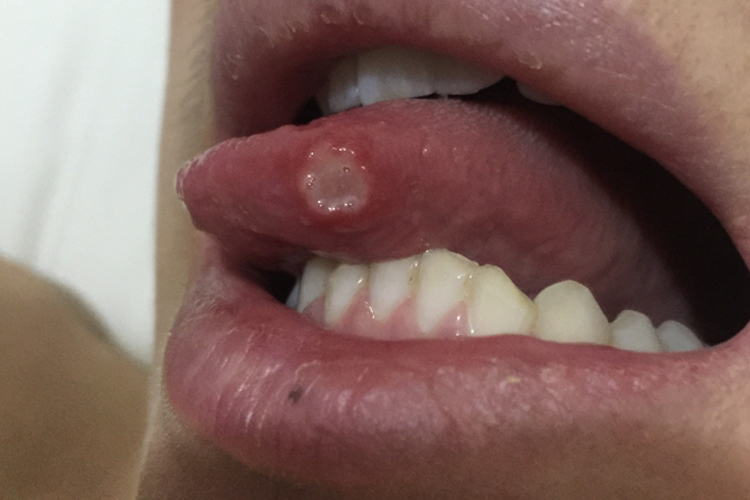 舌头下面口腔溃疡图